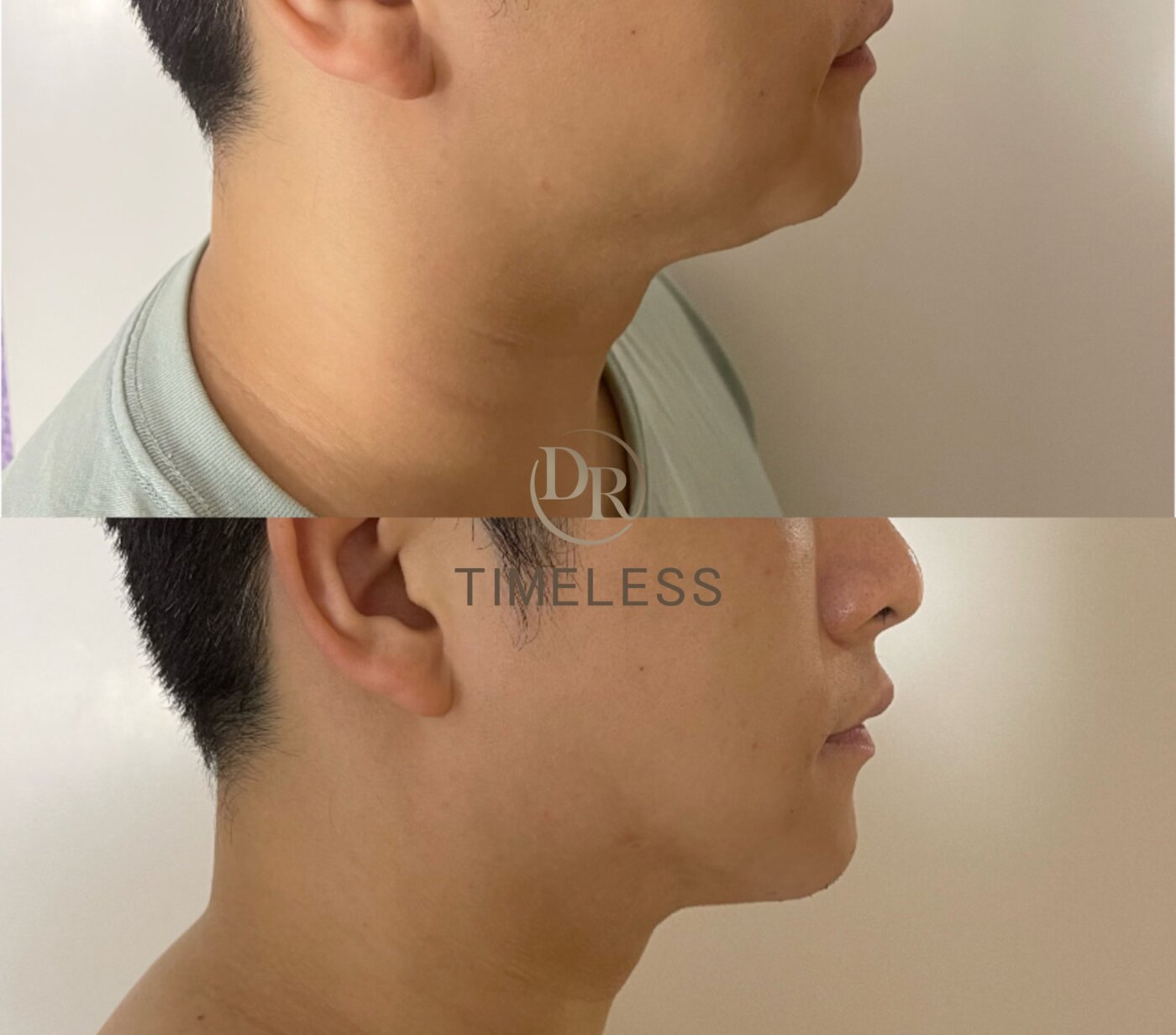 Doublo HIFU 超聲刀 面部線條緊緻 Before/After · Dr Timeless