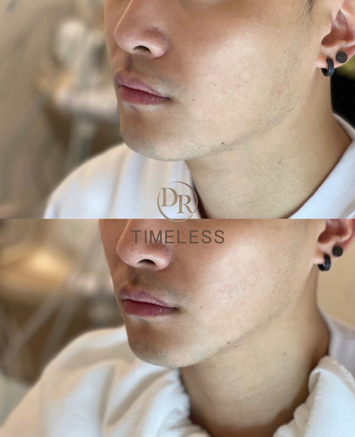 Doublo HIFU 超聲刀 面部拉提 Before/After · Dr Timeless