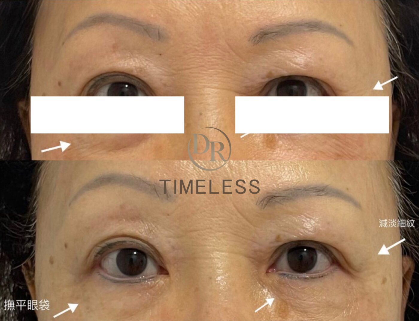 Doublo HIFU 超聲刀 V面緊緻 Before/After · Dr Timeless